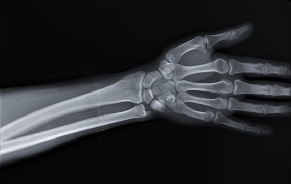 normal radiography of hand and wrist bones, traumatology and orthopedics