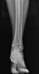 normal radiograph of the ankle joint