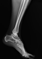 normal radiograph of the ankle joint