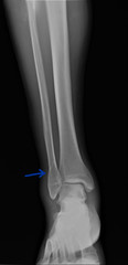 radiograph of the ankle joint with a fracture of the outer ankle without displacement,...