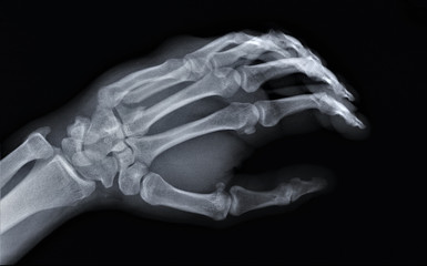 normal x-ray of the hand bones and fingers,orthopedics, medical diagnostics, rheumatology