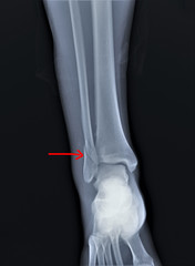 radiograph of the ankle joint with a fracture of the outer ankle without displacement,...