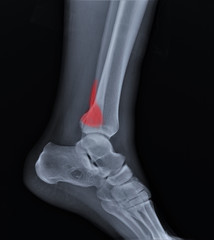 radiograph of the ankle joint with a fracture of the outer ankle without displacement,...