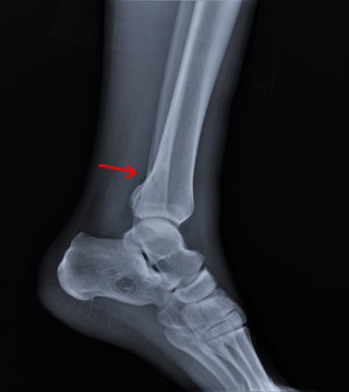 radiograph of the ankle joint with a fracture of the outer ankle without displacement, traumatology, medical diagnostics