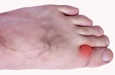 Inflamed swollen fingers caused by tumors