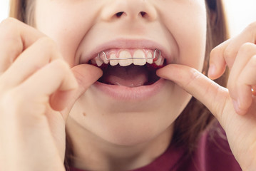 Child with removable orthodontic appliance in mouth. Concept of healthy teeth and a beautiful smile. 