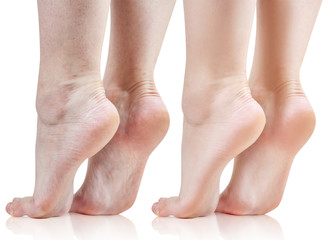 Female feet with dry skin before and after treatment or retouch.