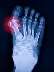  X-ray foot and arthritis at metatarsophalangeal joint (Big toe area)