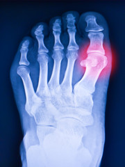 X-ray foot and arthritis at metatarsophalangeal joint (Big toe area)