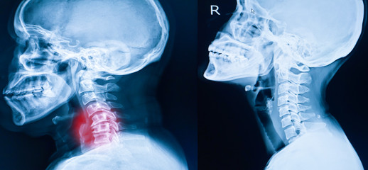 x-ray image of cervical spine, neck x-ray image