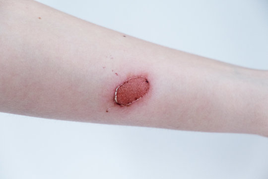 Second degree burn of a woman's hand on white background