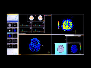 Magnetic Resonance (MR) spectroscopy of the brain for  identifies the anatomical location of a...