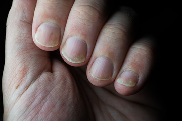 Psoriasis is an autoimmune disease that affects the nail and skin. close up of Psoriasis nail on...