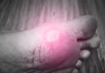 Close-up of corn on woman's foot sole. foot and shoes problem. medecine concept. Black and white tone with red spot on corn