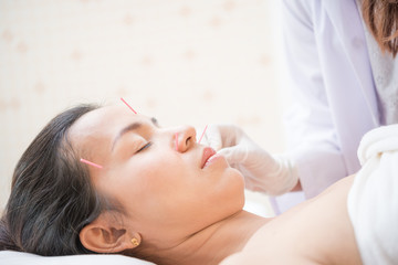 Fototapeta na wymiar Woman receiving facial acupuncture treatment