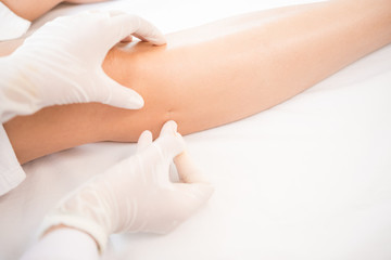 Fototapeta na wymiar Therapy of female leg with pricking acupuncture needles