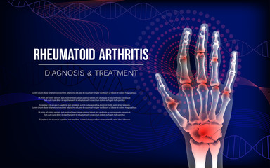 Rheumatoid arthritis osteoarthritis banner inflammation joints of bones of hand. - obrazy, fototapety, plakaty