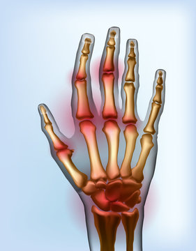 Frontal view image sore osteoarthritis joints of bones the of hand.