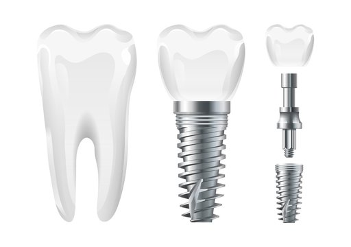 Dental Surgery. Implant Cut And Healthy Tooth. Realistic Vector Dental Implant And Crown. Stomatology Elements Tooth, Dental Care And Treatment Illustration