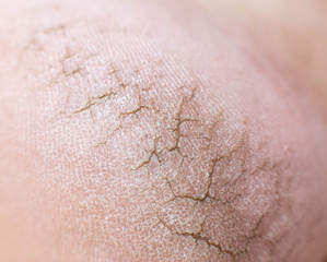 Fototapeta premium Dry cracked skin on the heels of a person s legs, close-up. Concept of serious skin diseases and fungal infection, macro, metabolic processes