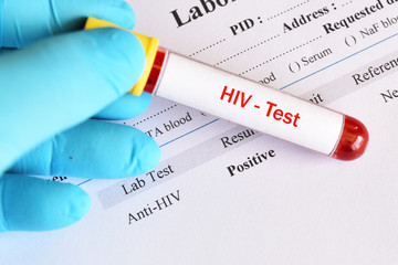 HIV positive test result with blood sample tube