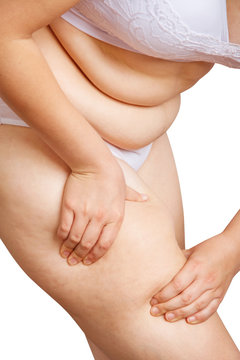 Fat and flabby female hips with cellulite.