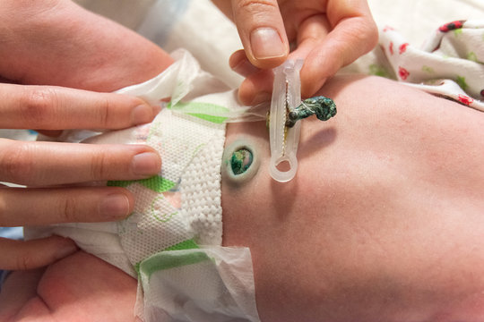 umbilical wound of the newborn, care for the navel in infants