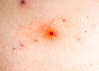 Fototapeta premium Many birthmarks on the girl's back. Medical health photo. Woman's oily skin with problems acne.