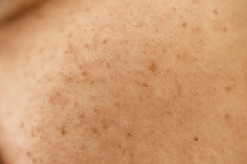 Woman 's problematic skin , acne scars ,oily skin and pore, dark spots and blackhead and whitehead...