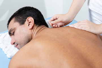 Therapist adjusting acupuncture needles on man back in aculpulture treatment.