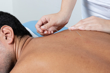 Detail of therapist's hands adjusting needles on back of man in aculpultura treatment.