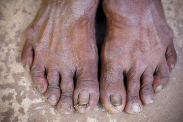 Dirty feet, wrinkled skin, abnormal toes