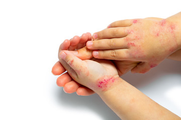 children hand with dermatitis. eczema on hand. Isolated on the white background