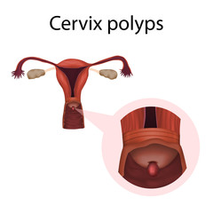 Cervix polyps. Abnormal growth of tissue. Medical anatomy illustration.