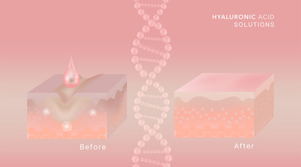 Hyaluronic acid before and after skin solutions ad, pink collagen serum drop with cosmetic advertising background ready to use, illustration vector.	