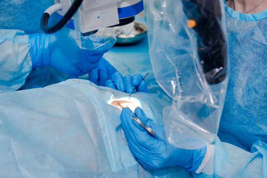 Close Up Of Surgery Team Operating. The Operation On The Eye. Cataract Surgery. Laser Vision Correction. Patient And Team Of Surgeons In The Operating Room, Patient Under Sterile Cover