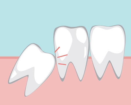 A wisdom tooth makes problem for molars in the gum, a vector stock illustration with adult jaw and teeth for orthodontic services