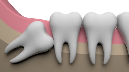 Wisdom tooth horizontal, 3D-rendering, white background