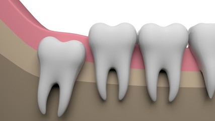 Wisdom tooth, 3D-rendering, white background