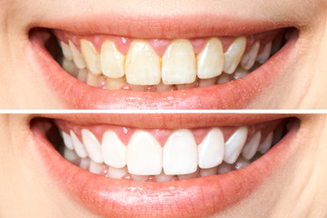 woman teeth before and after whitening. Over white background. Dental clinic patient. Image...