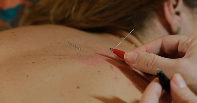 Acupuncturist attaching electrodes to needles in order to perform acupuncture with electric stimulation to release pain on woman's back. Modern approach to Chinese traditional medicine.