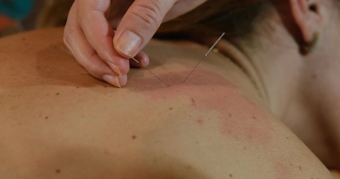 Acupuncturist inserting acupuncture needles into a red area of a woman's back in order to release pain and inflammation. Traditional Chinese medicine procedure.