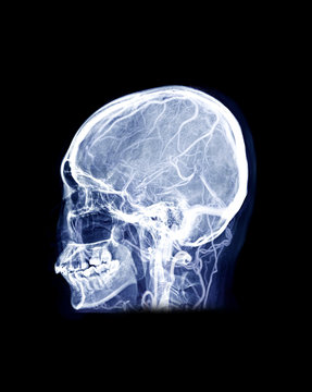  Skull x-ray image of Human skull Lateral mix MRV Brain image showing Venous sinuses of brain in skull.