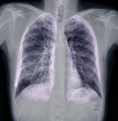 Chest X-ray or X-Ray Image Of Human Chest with 3D rendering of lung for diagnosis tuberculosis ....