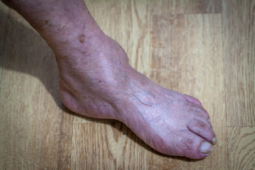closeup feet of old an suffering from leprosy