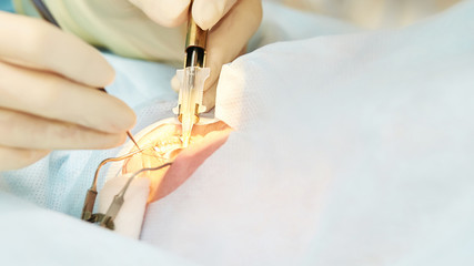 Ophthalmology laser microscope operation. Doctor in clinic. Patient eye treatment. Myopia and...