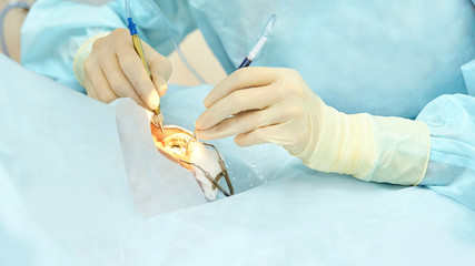 Ophthalmology laser microscope operation. Doctor in clinic. Patient eye treatment. Myopia and...