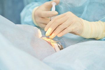 Ophthalmology laser microscope operation. Doctor in clinic. Patient eye treatment. Myopia and...