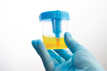 Urine analysis in the laboratory. Medical urine test. Urine sample for laboratory analysis.