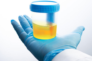 Urine analysis in the laboratory. Medical urine test. Urine sample for laboratory analysis.
